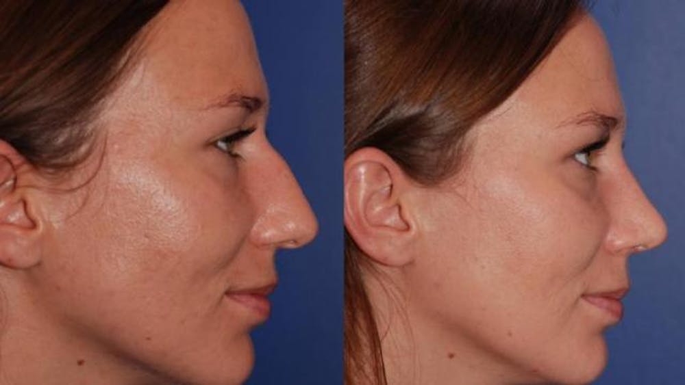 Rhinoplasty Before and After in Denver Colorado Rhinoplasty Before and After in Denver Colorado