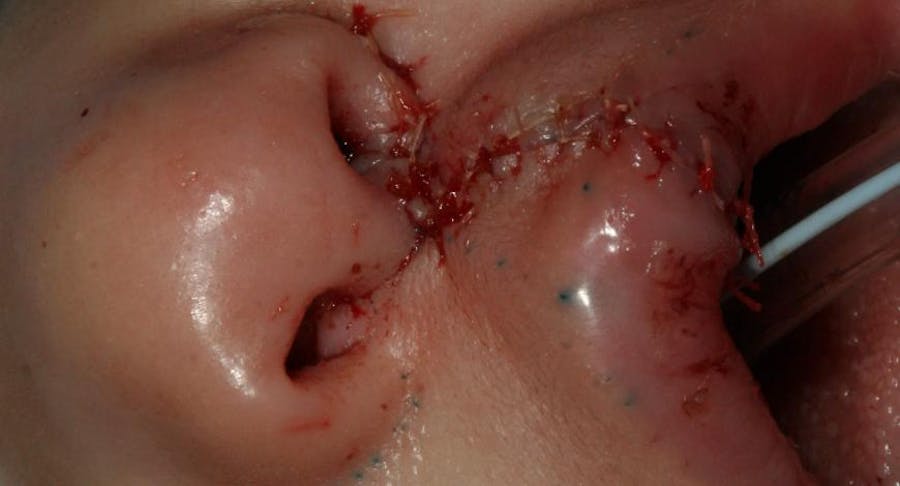 childs mouth with stiches