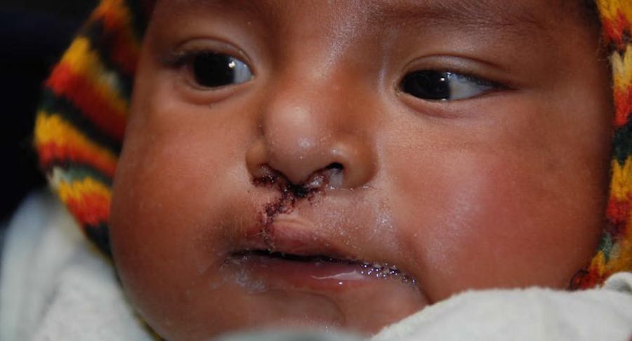 picture of baby post-op