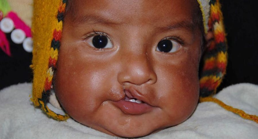 Picture of child with clef lip