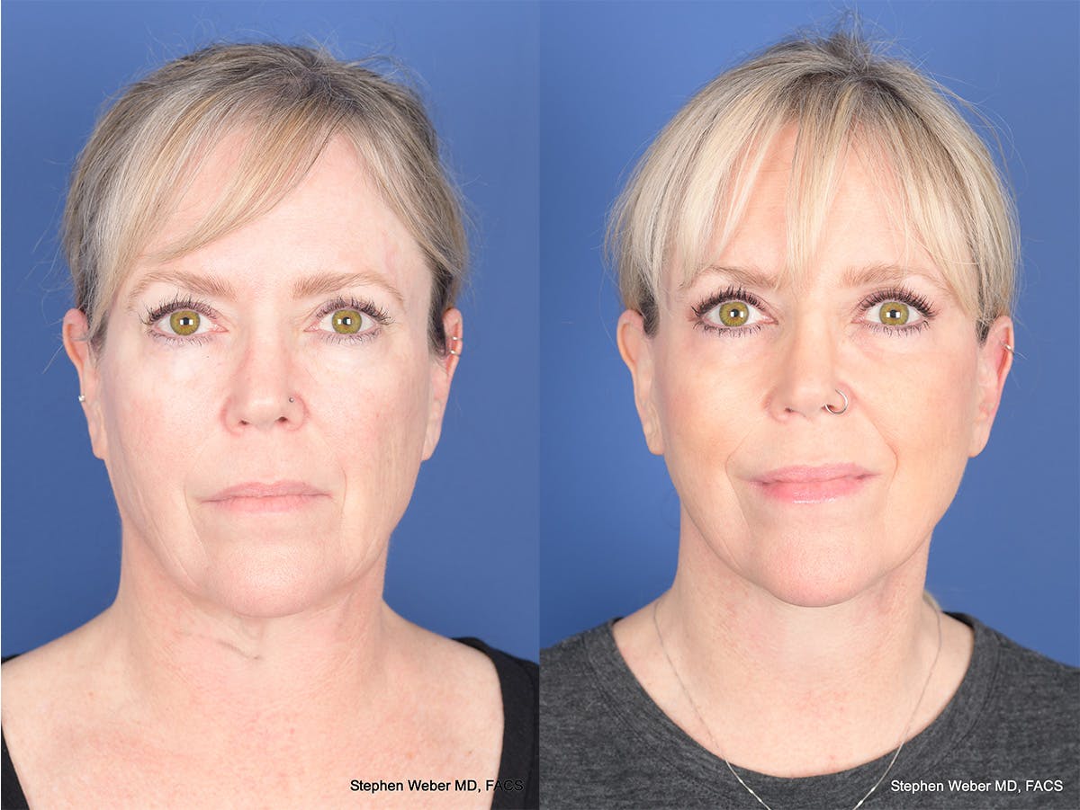 Facelift Before & After Gallery - Patient 337183 - Image 1