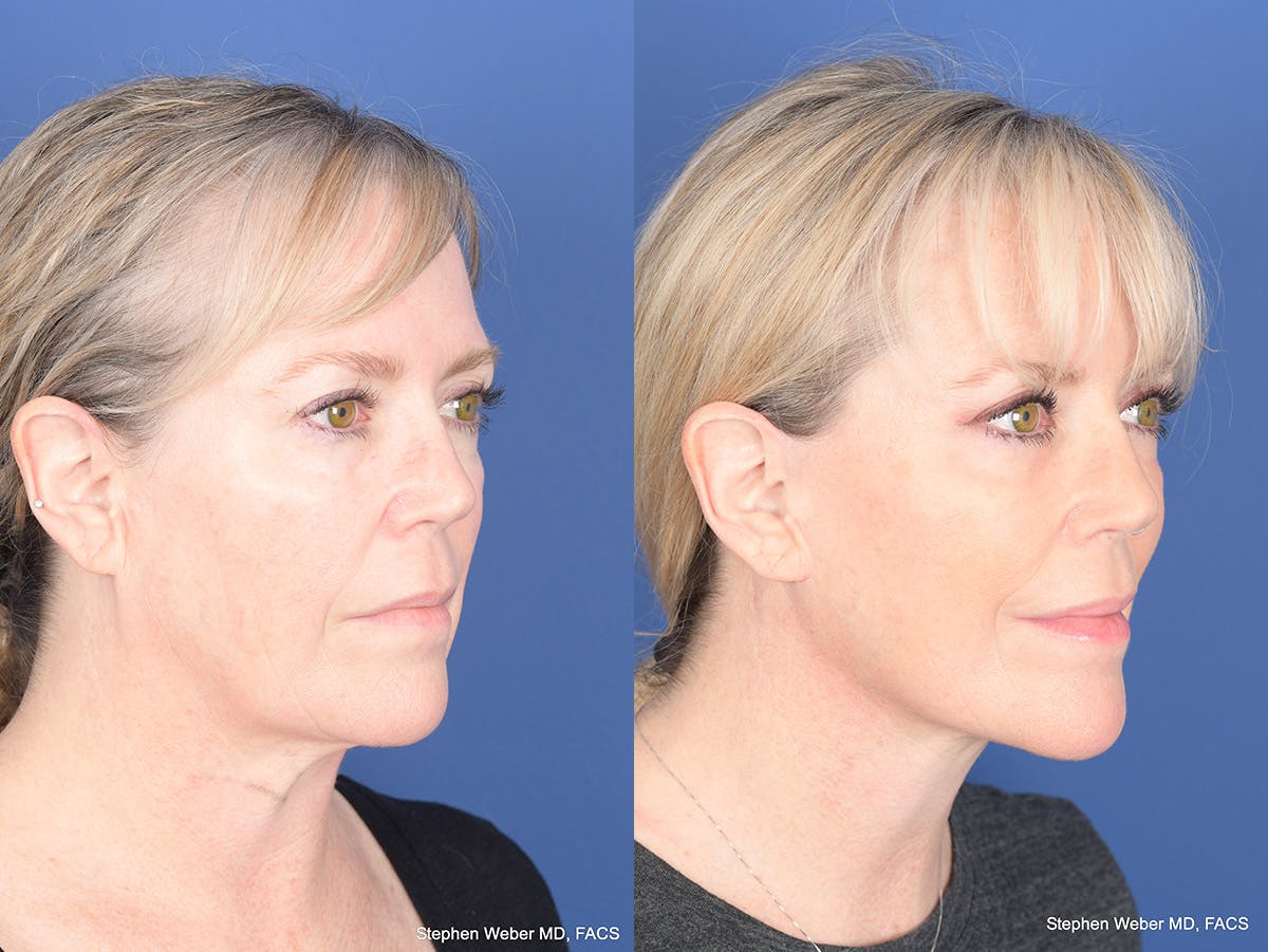 Facelift Before & After Gallery - Patient 337183 - Image 2