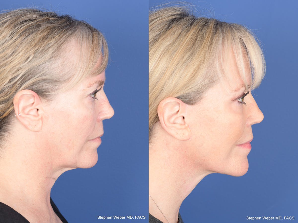 Facelift Before & After Gallery - Patient 337183 - Image 3