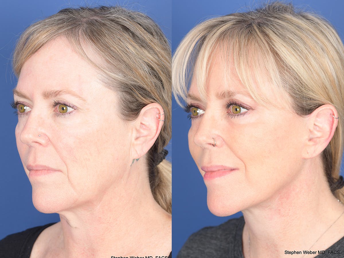 Facelift Before & After Gallery - Patient 337183 - Image 4
