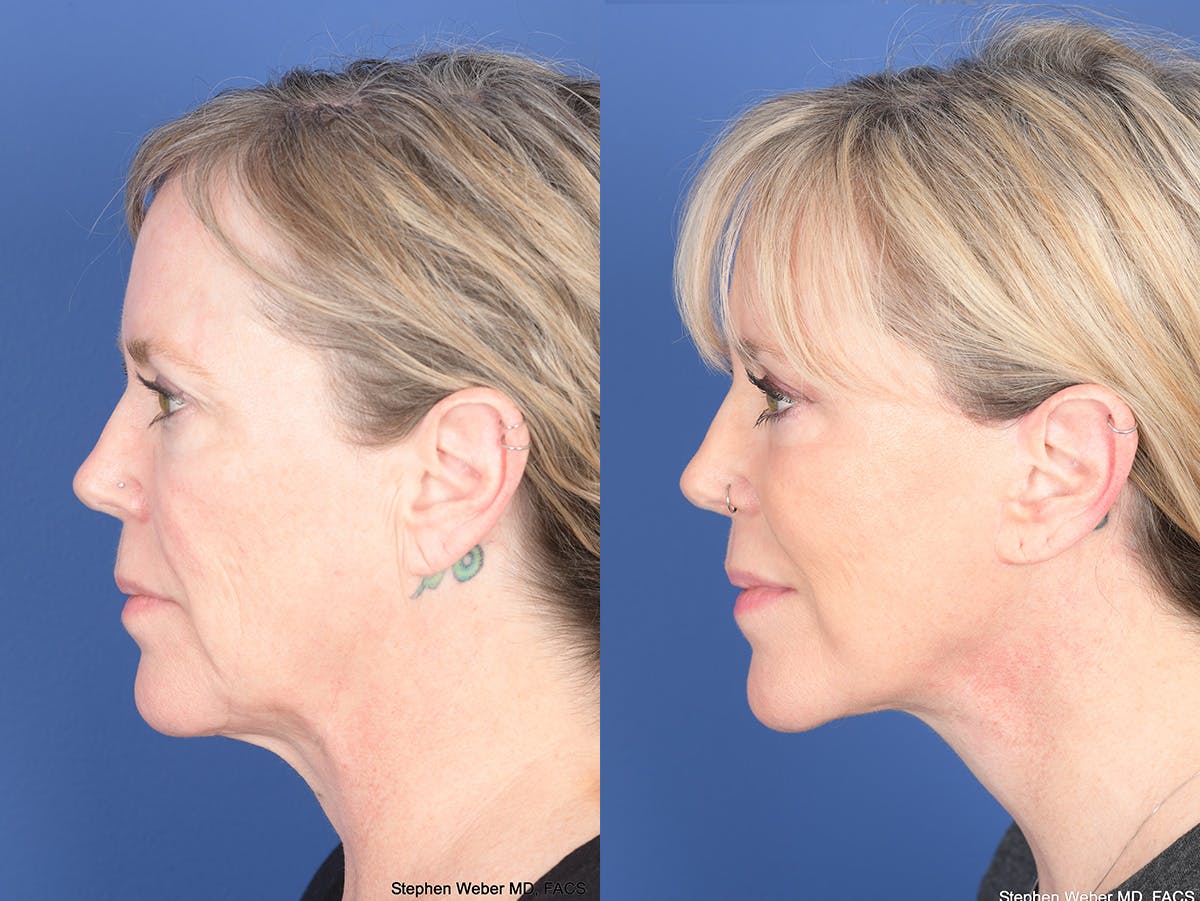 Facelift Before & After Gallery - Patient 337183 - Image 5