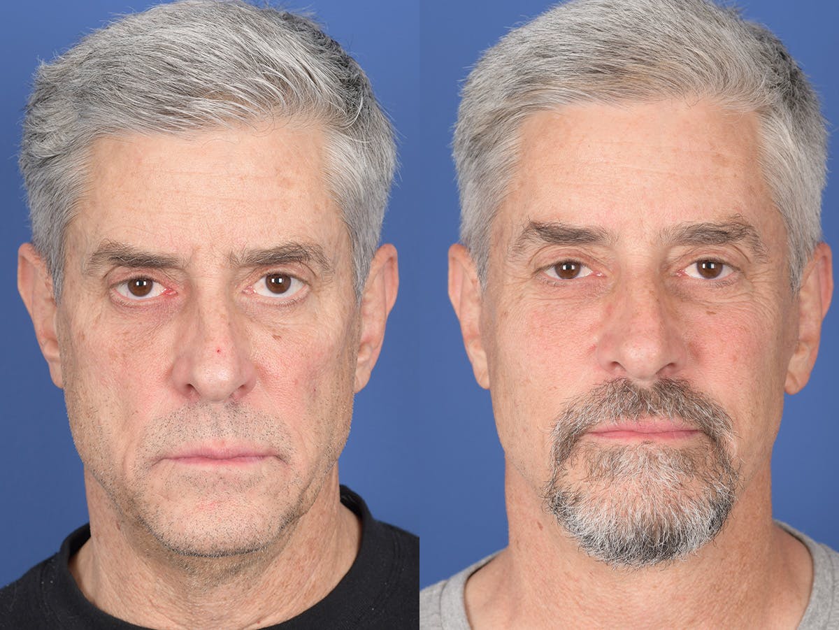 Fat Transfer Before & After Gallery - Patient 419082 - Image 1