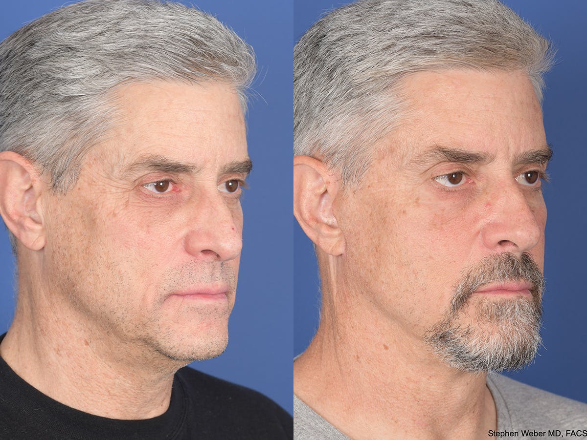Fat Transfer Before & After Gallery - Patient 419082 - Image 2