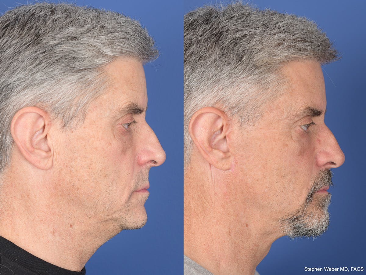 Fat Transfer Before & After Gallery - Patient 419082 - Image 3