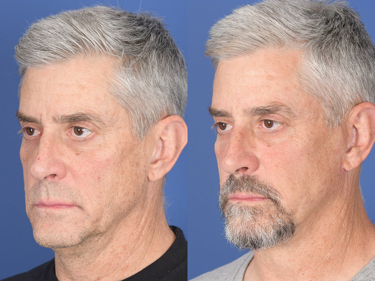 Fat Transfer Before & After Gallery - Patient 419082 - Image 4