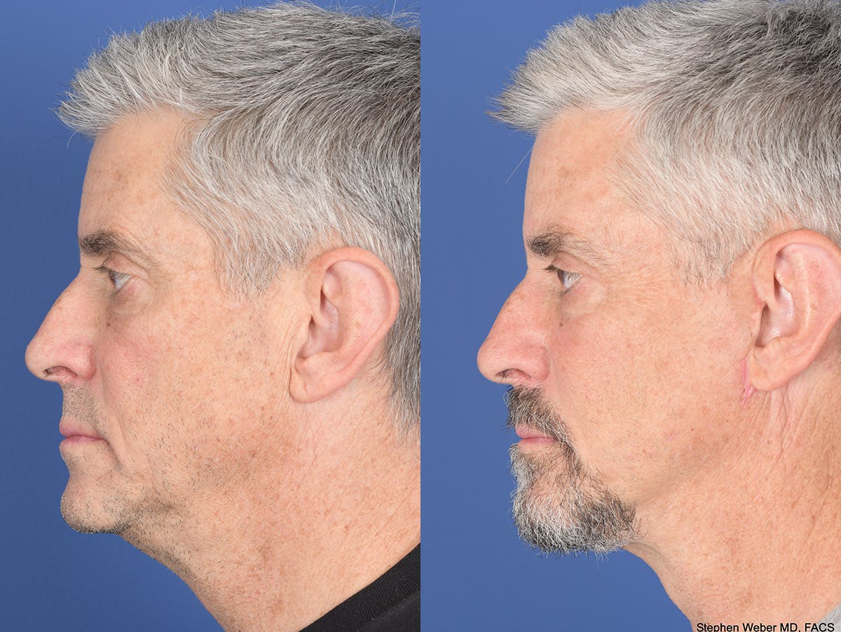 Fat Transfer Before & After Gallery - Patient 419082 - Image 5