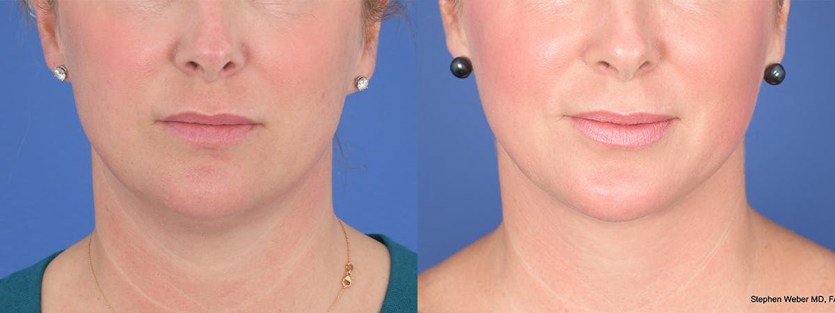Liposuction Before & After Gallery - Patient 533375 - Image 1