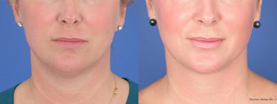 Liposuction Before & After Gallery - Patient 533375 - Image 1
