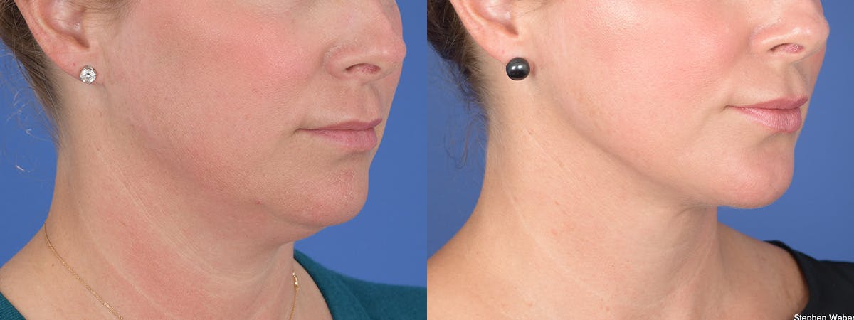 Liposuction Before & After Gallery - Patient 533375 - Image 3