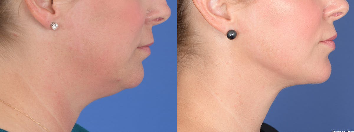 Liposuction Before & After Gallery - Patient 533375 - Image 2