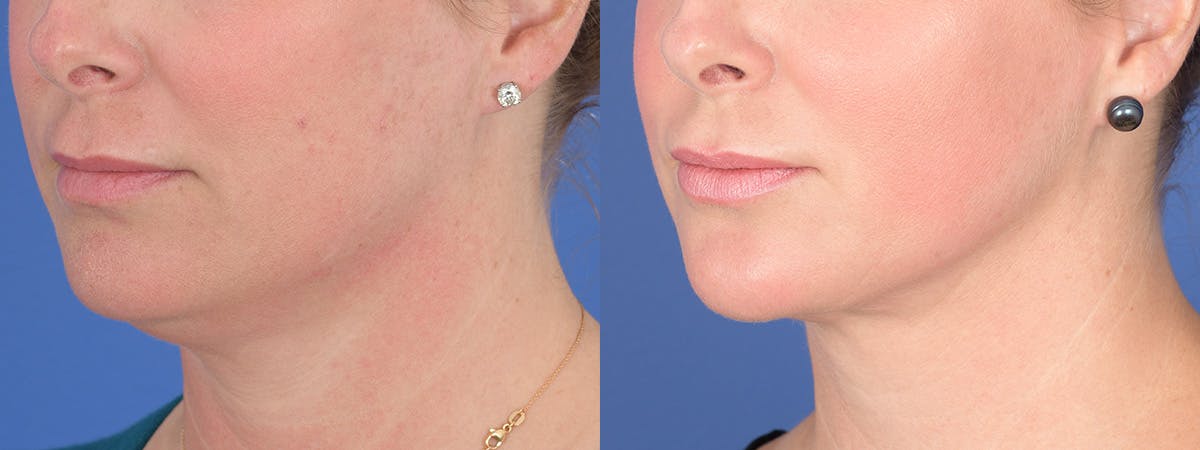 Liposuction Before & After Gallery - Patient 533375 - Image 4