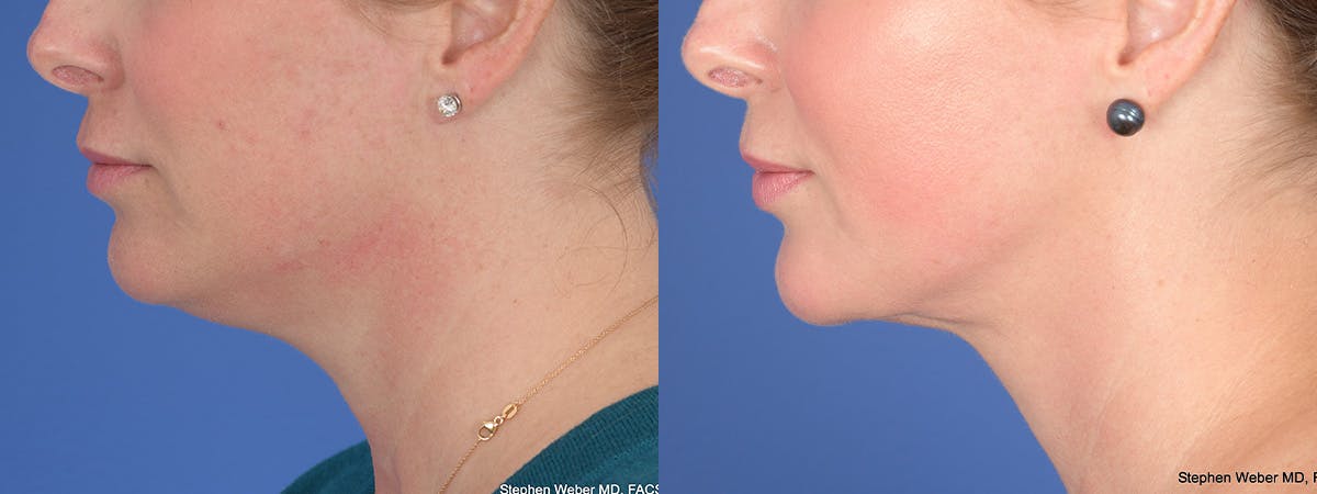 Liposuction Before & After Gallery - Patient 533375 - Image 5