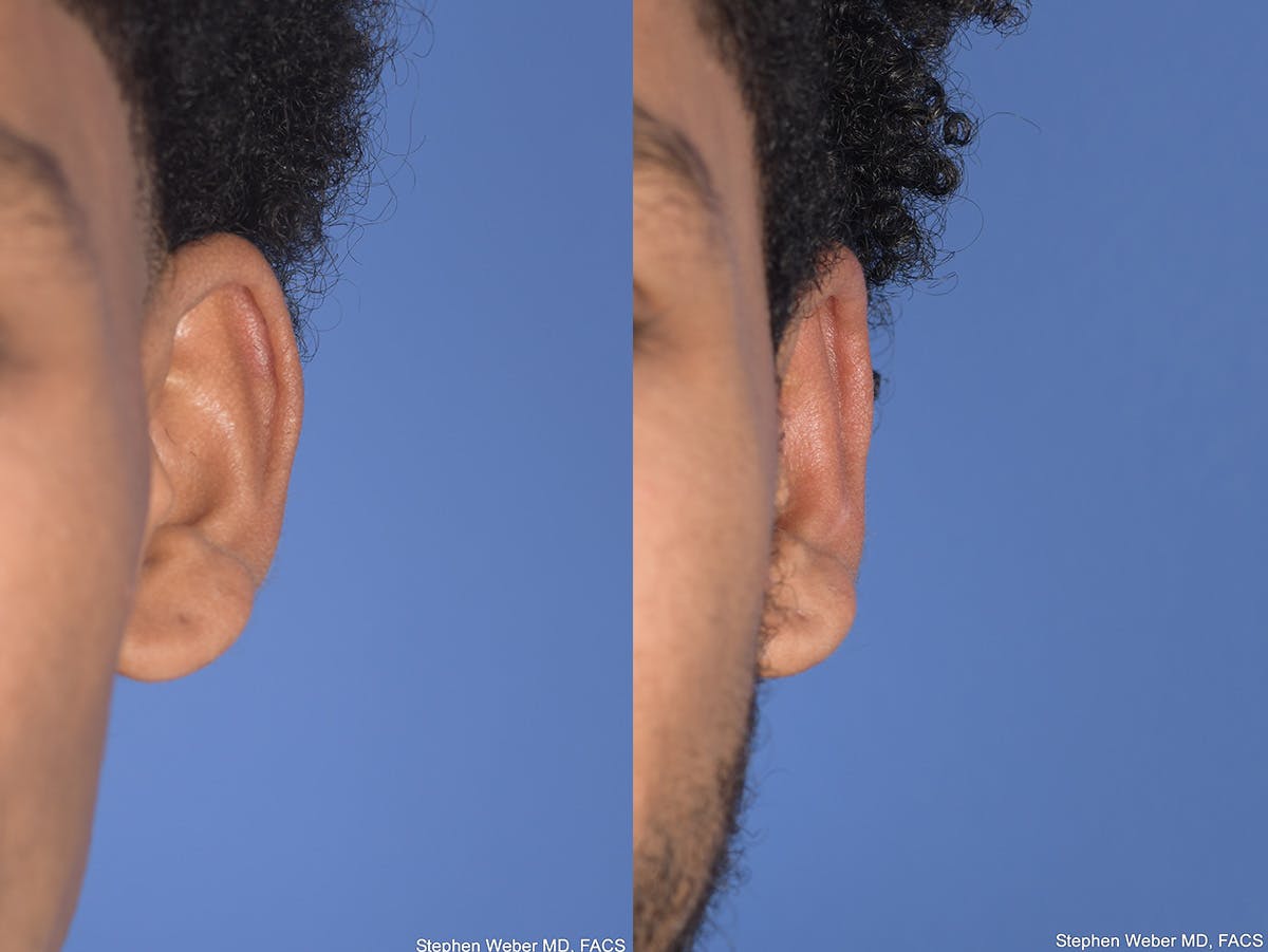 Otoplasty Before & After Gallery - Patient 394023 - Image 1