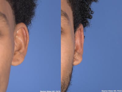 Otoplasty Before & After Gallery - Patient 394023 - Image 1