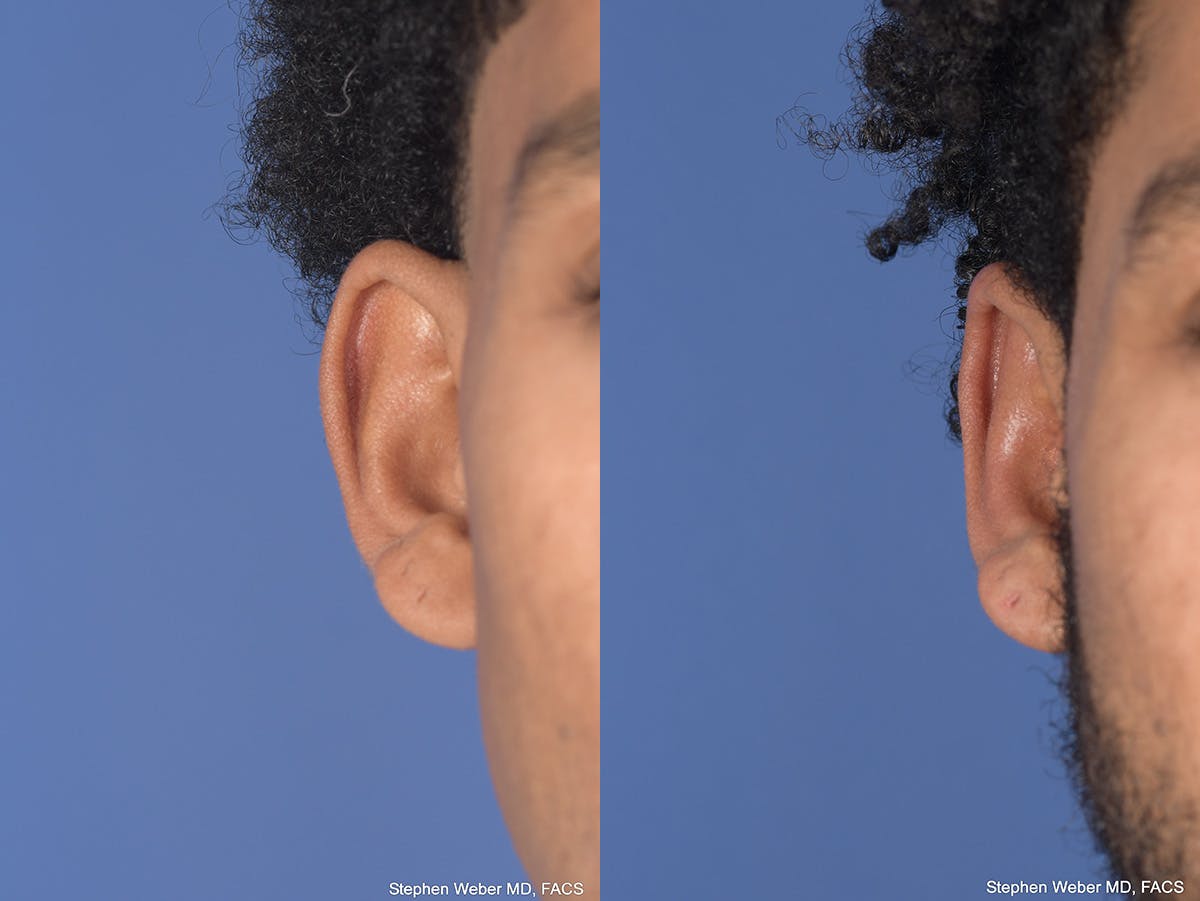 Otoplasty Before & After Gallery - Patient 394023 - Image 2