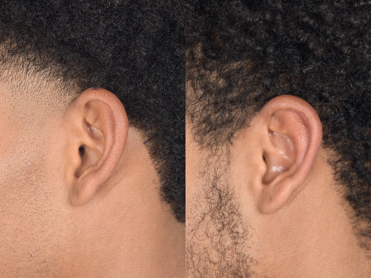 Otoplasty Before & After Gallery - Patient 394023 - Image 6