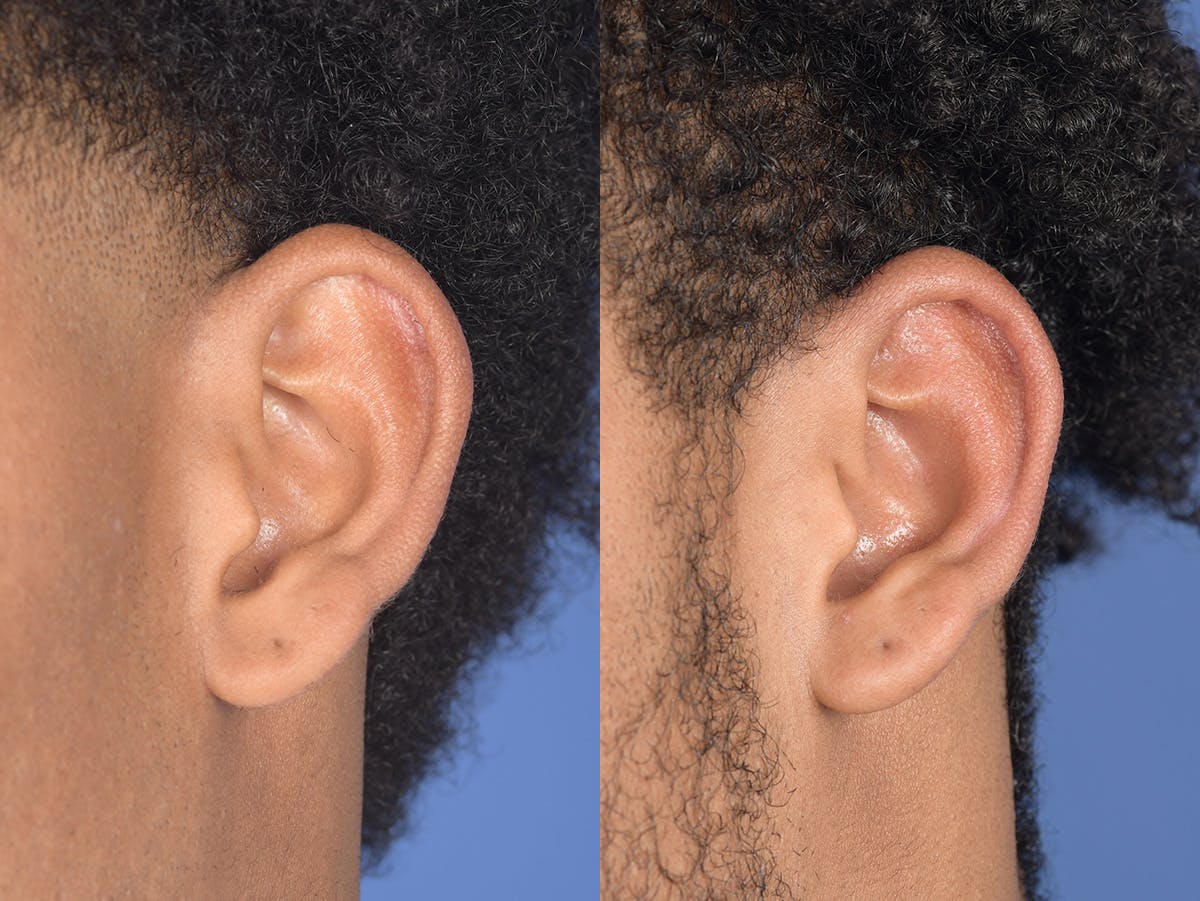 Otoplasty Before & After Gallery - Patient 394023 - Image 4
