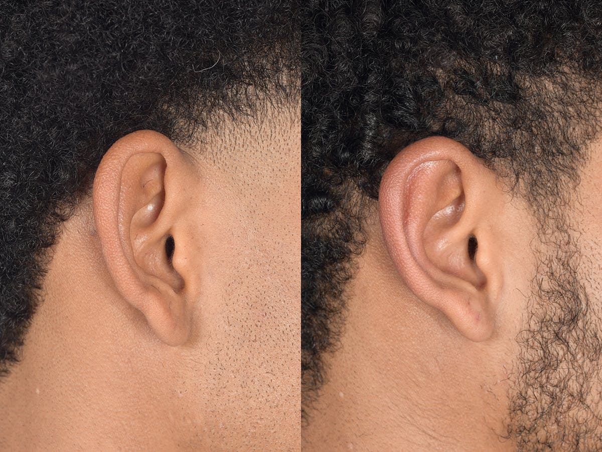Otoplasty Before & After Gallery - Patient 394023 - Image 5
