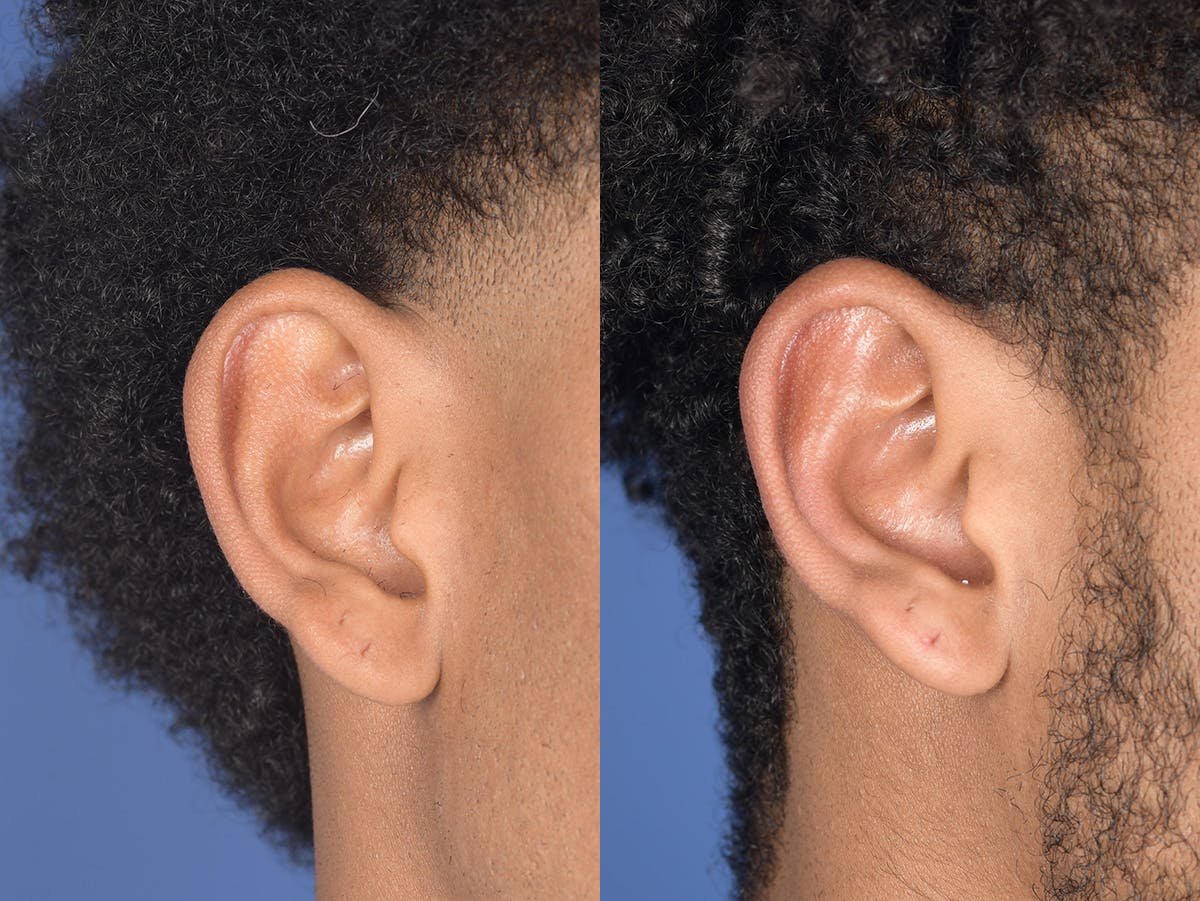Otoplasty Before & After Gallery - Patient 394023 - Image 3