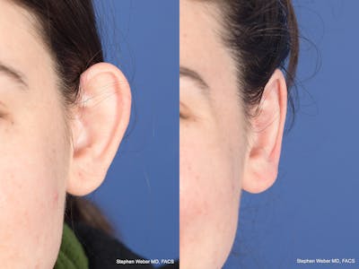 Otoplasty Before & After Gallery - Patient 284279 - Image 1