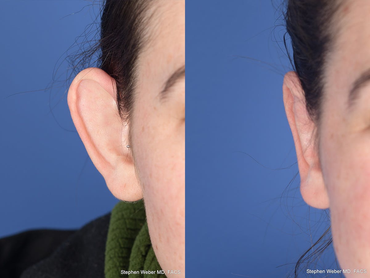 Otoplasty Before & After Gallery - Patient 284279 - Image 2
