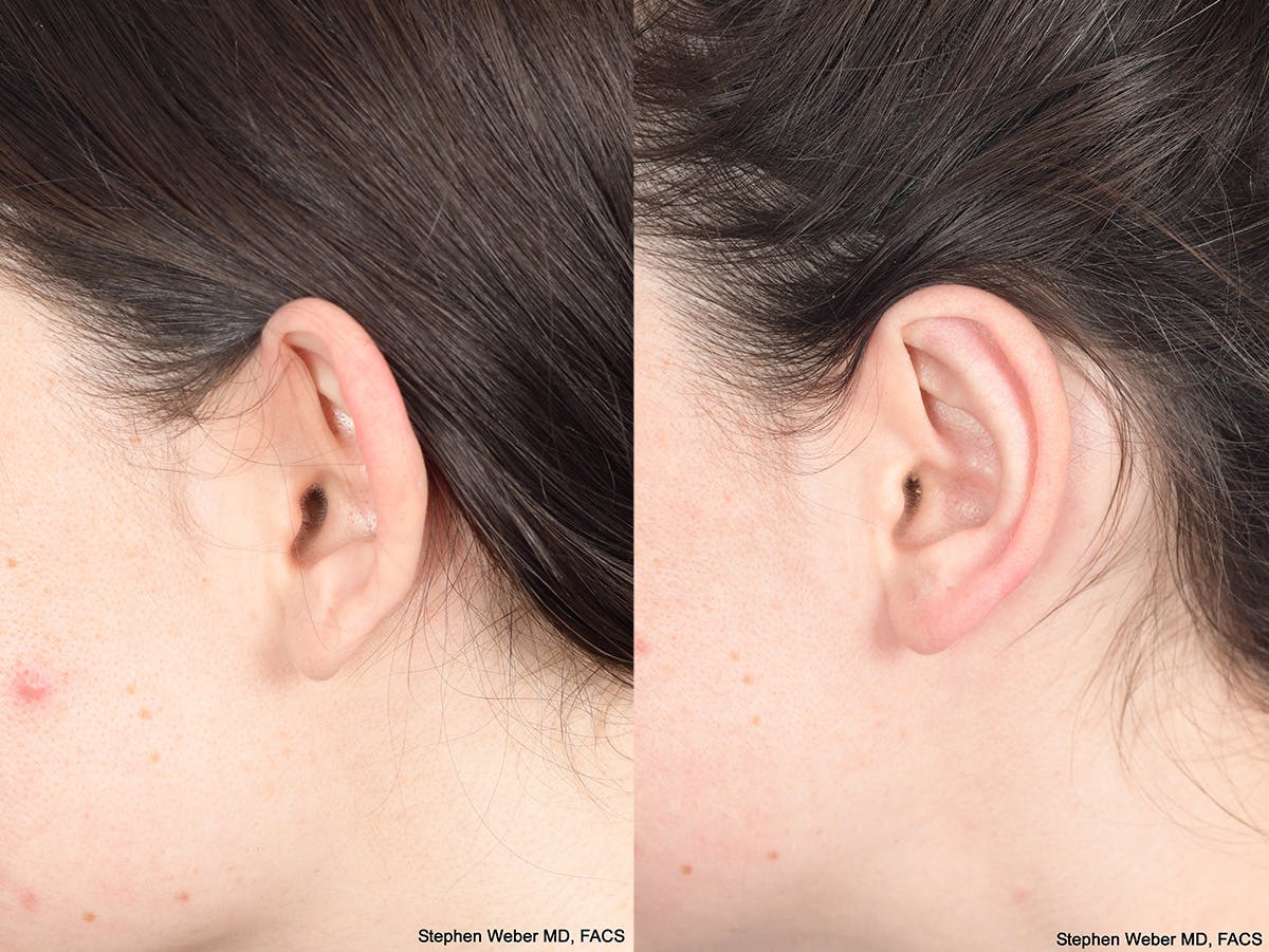 Otoplasty Before & After Gallery - Patient 284279 - Image 6
