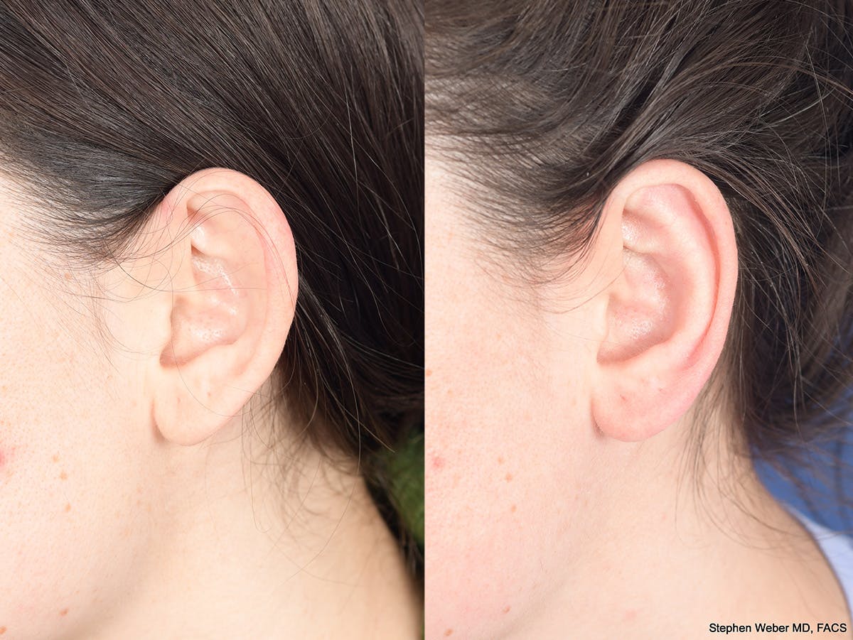 Otoplasty Before & After Gallery - Patient 284279 - Image 4
