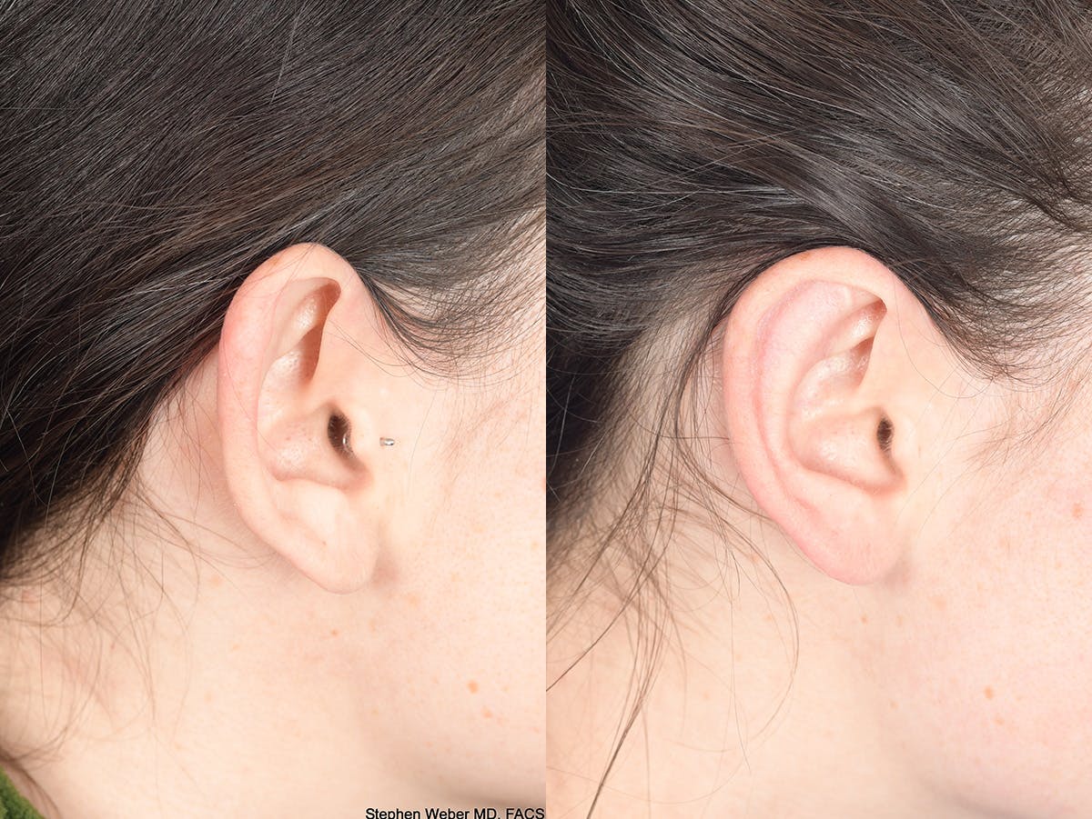 Otoplasty Before & After Gallery - Patient 284279 - Image 5