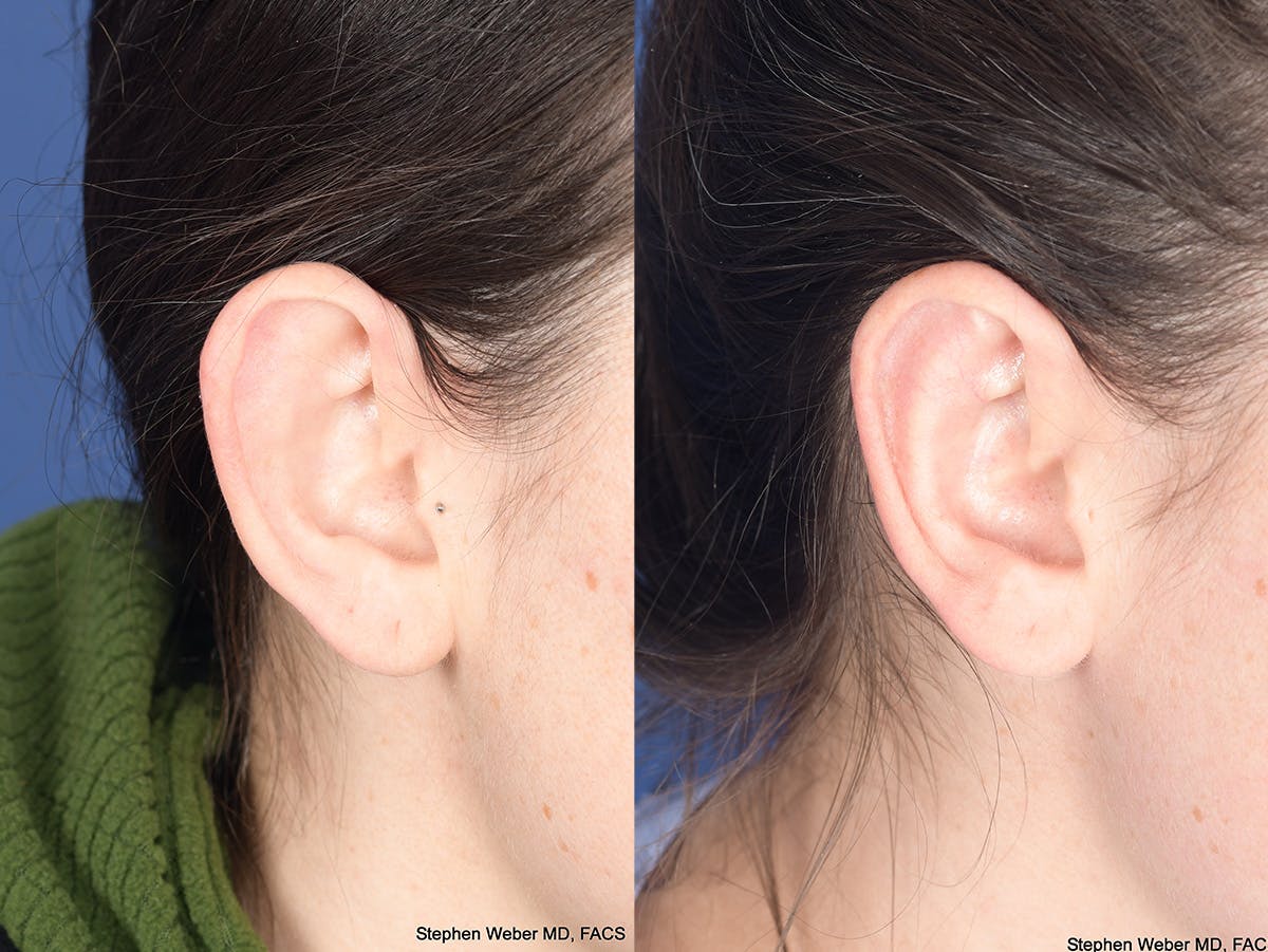 Otoplasty Before & After Gallery - Patient 284279 - Image 3