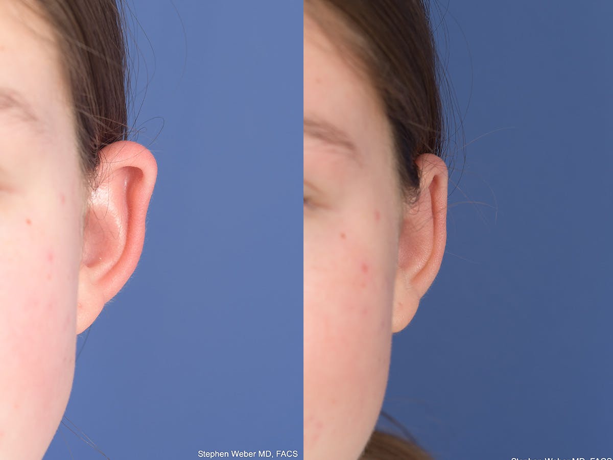 Otoplasty Before & After Gallery - Patient 406137 - Image 1