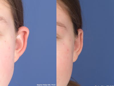Otoplasty Before & After Gallery - Patient 406137 - Image 1