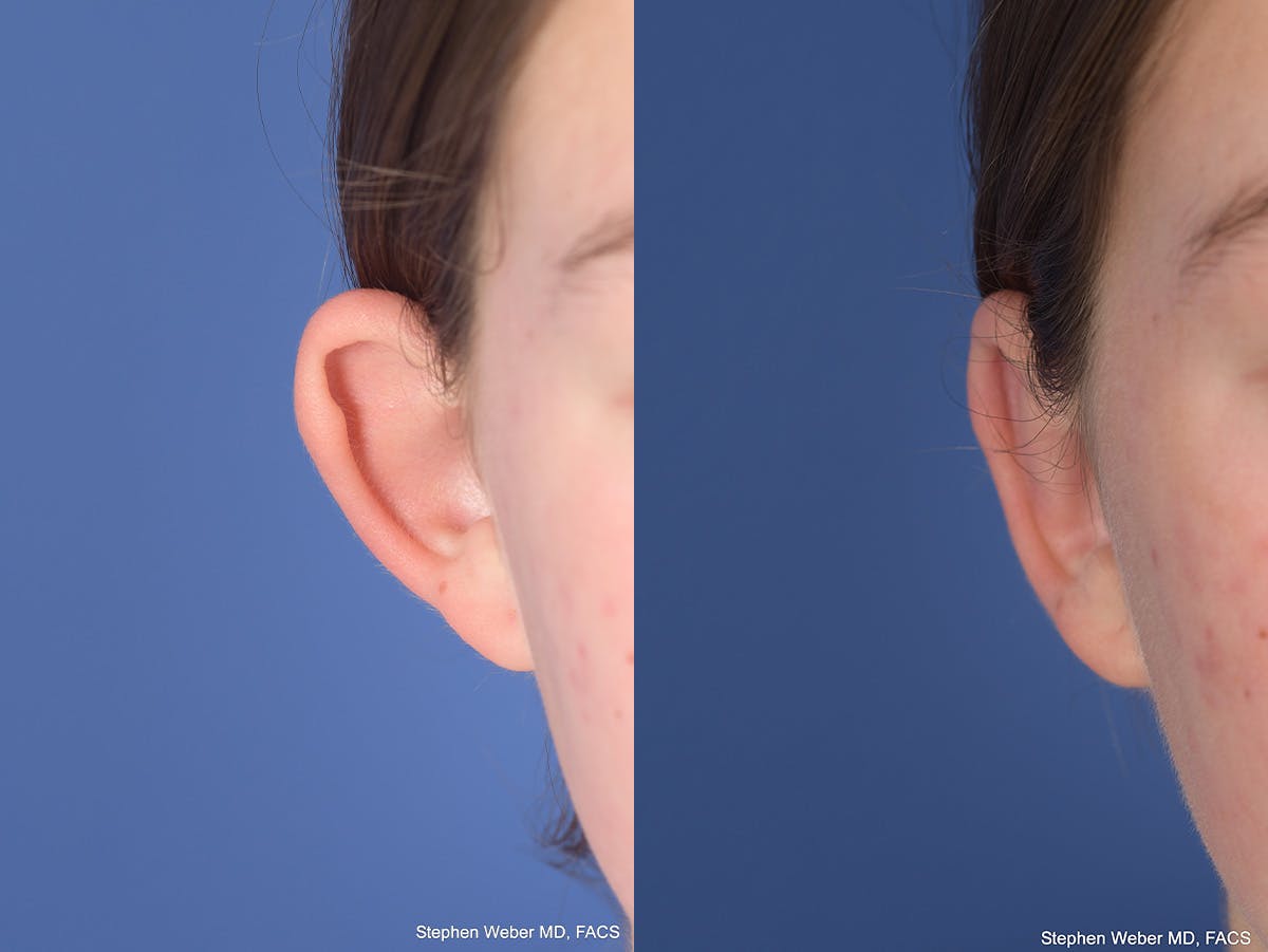 Otoplasty Before & After Gallery - Patient 406137 - Image 2