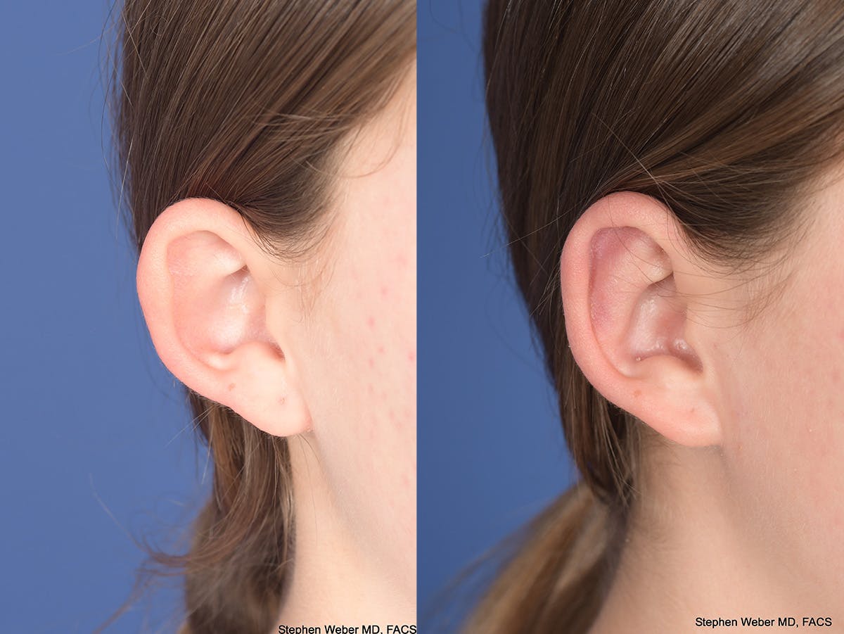 Otoplasty Before & After Gallery - Patient 406137 - Image 5