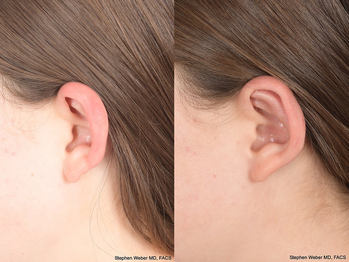 Otoplasty Before & After Gallery - Patient 406137 - Image 8