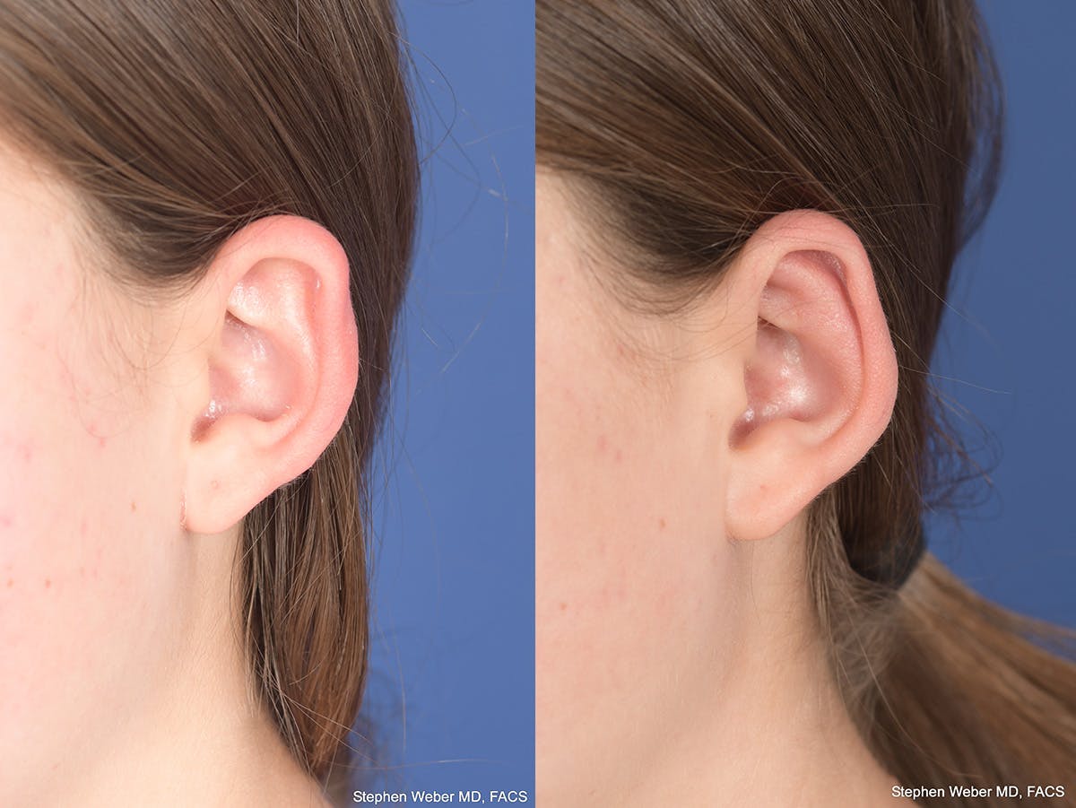 Otoplasty Before & After Gallery - Patient 406137 - Image 6