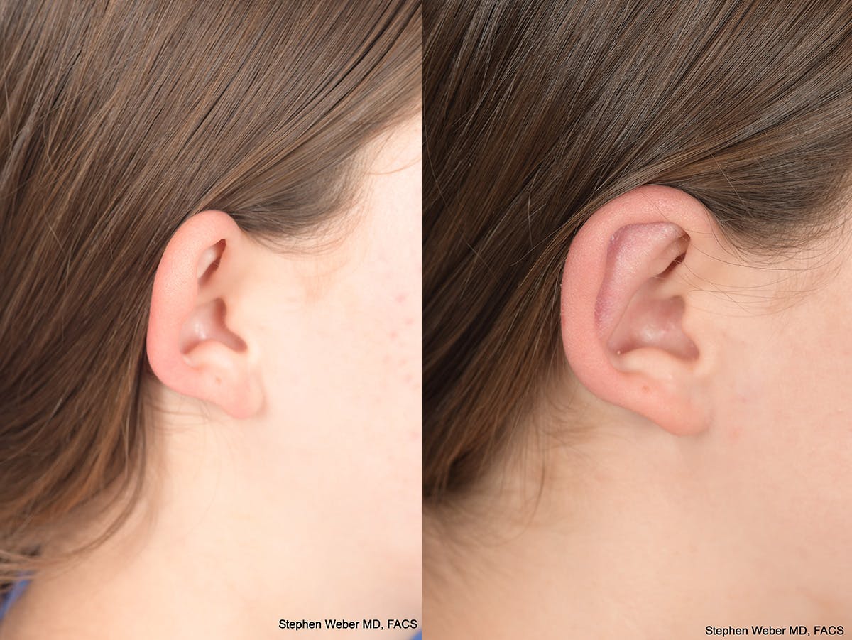 Otoplasty Before & After Gallery - Patient 406137 - Image 7