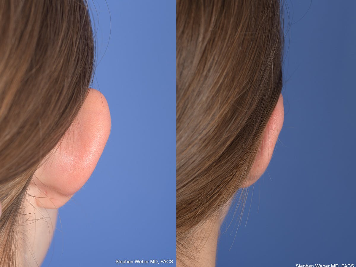 Otoplasty Before & After Gallery - Patient 406137 - Image 3
