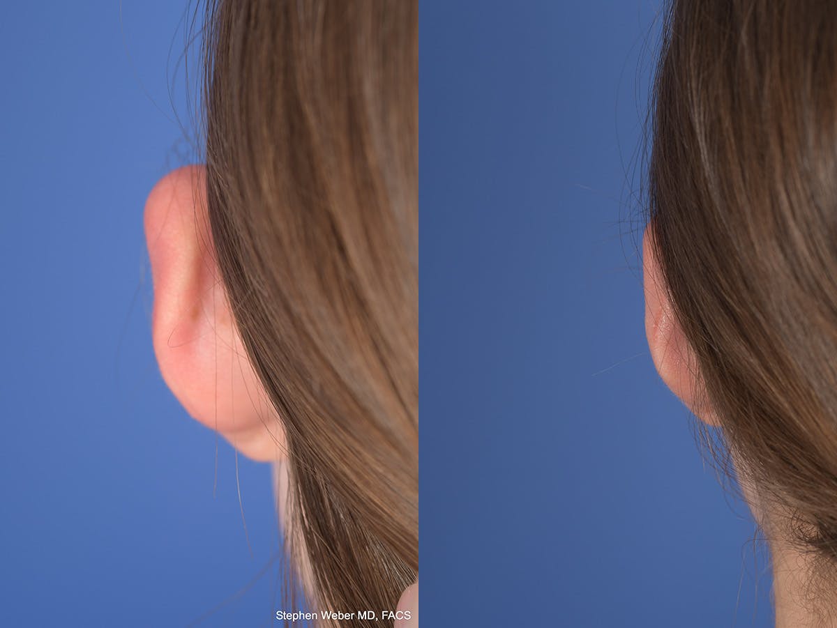 Otoplasty Before & After Gallery - Patient 406137 - Image 4