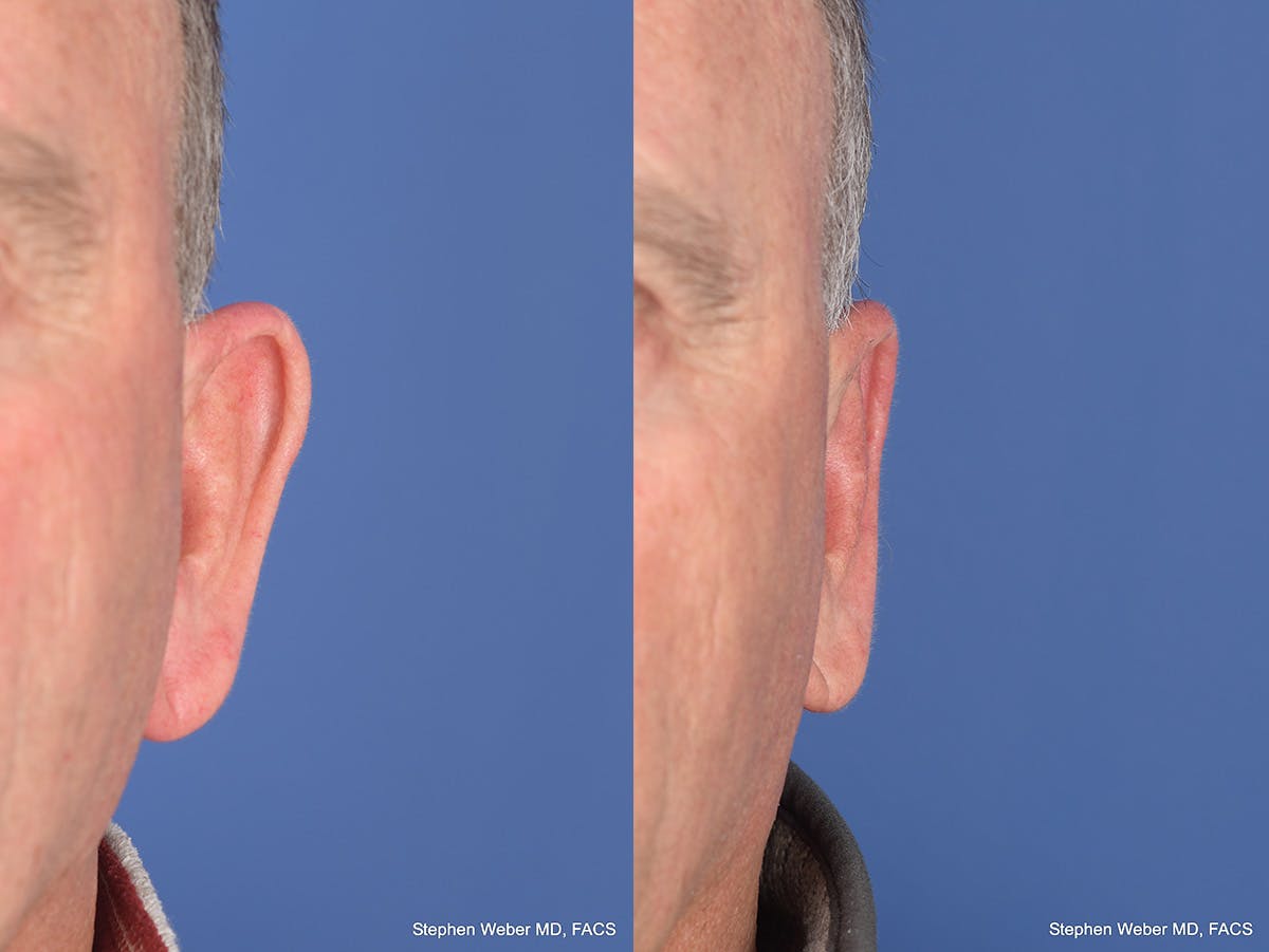 Otoplasty Before & After Gallery - Patient 408865 - Image 1