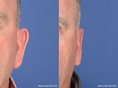 Otoplasty Before & After Gallery - Patient 408865 - Image 1