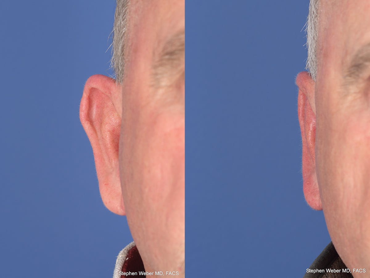 Otoplasty Before & After Gallery - Patient 408865 - Image 2