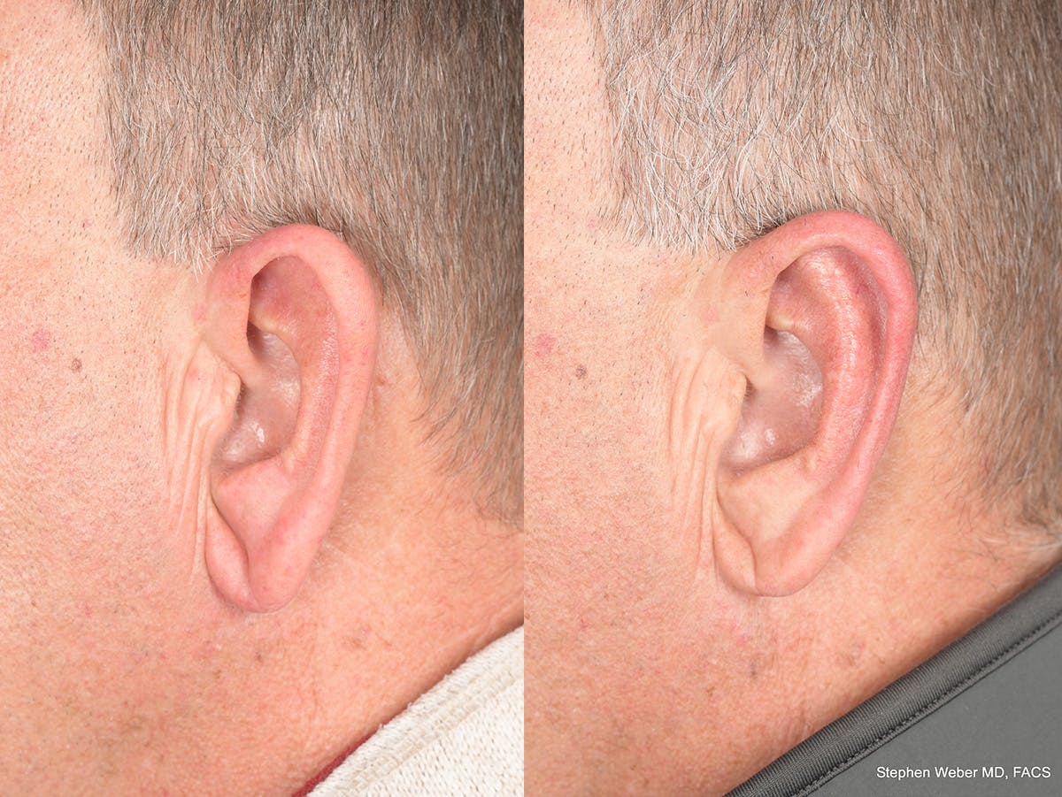 Otoplasty Before & After Gallery - Patient 408865 - Image 6
