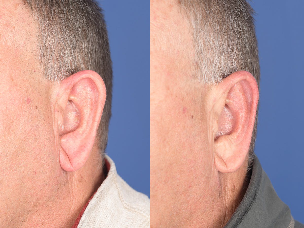 Otoplasty Before & After Gallery - Patient 408865 - Image 4