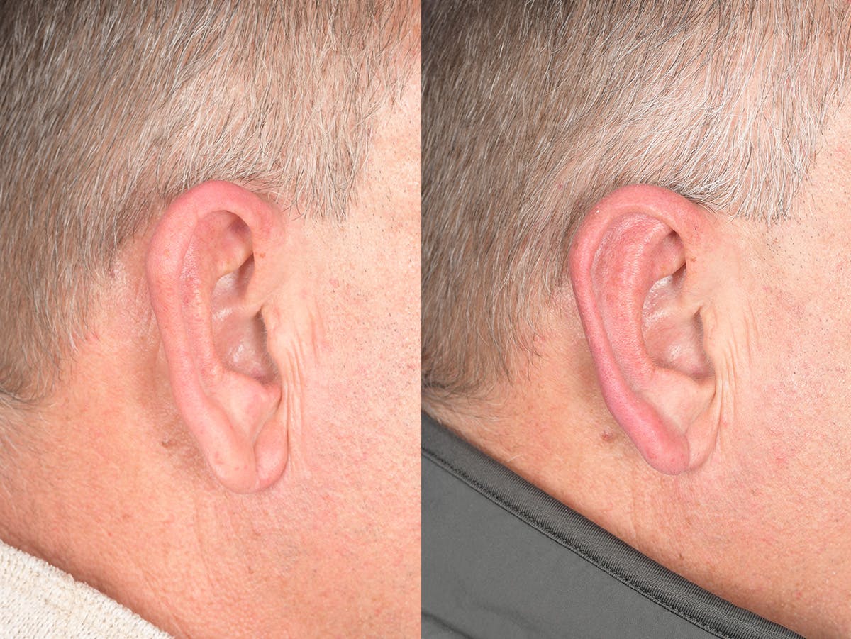 Otoplasty Before & After Gallery - Patient 408865 - Image 5