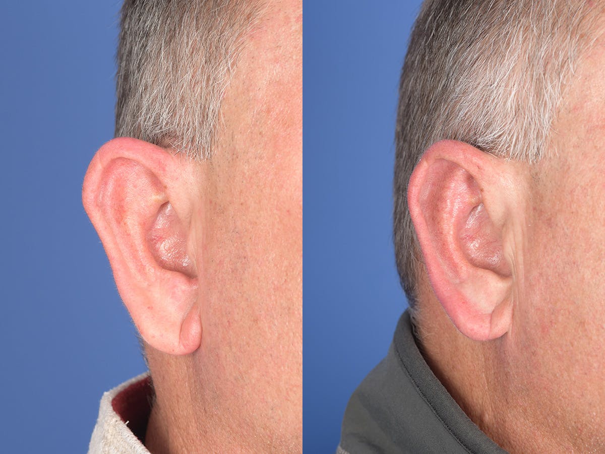 Otoplasty Before & After Gallery - Patient 408865 - Image 3