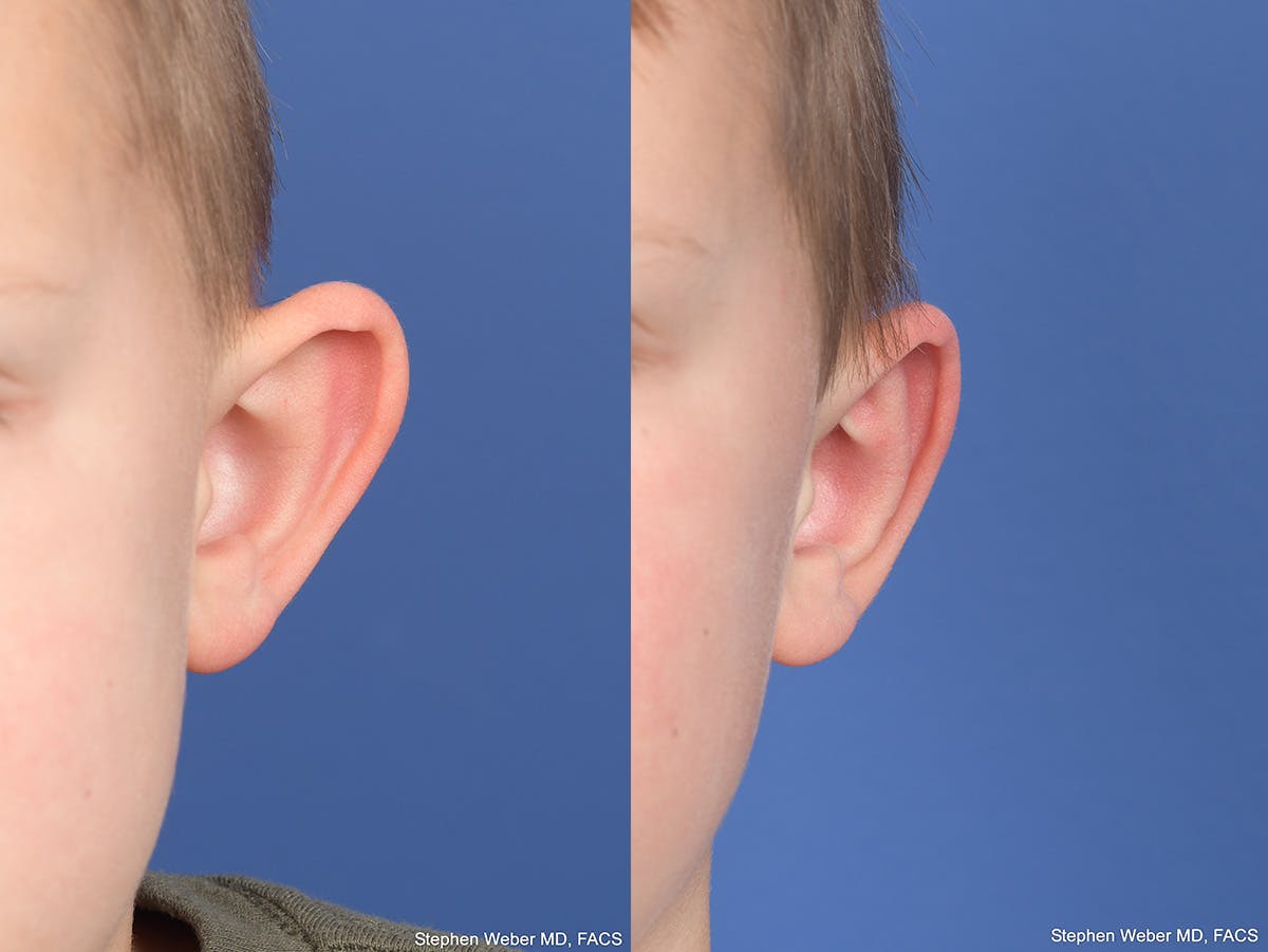 Otoplasty Before & After Gallery - Patient 191318 - Image 1